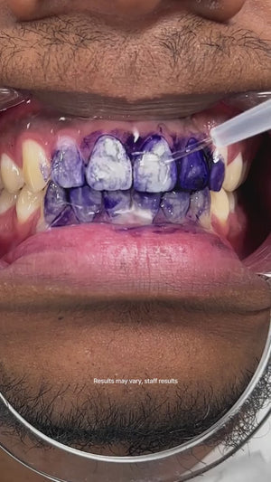 Teeth Whitening Serum V34 – Instant Brightening & Stain Corrector 30ml